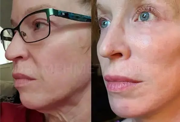 mehmet-comert-md-facelift-before-and-after-23-2