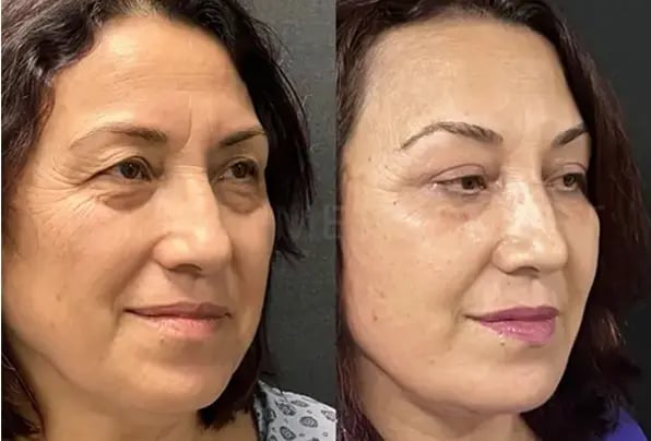 facelift