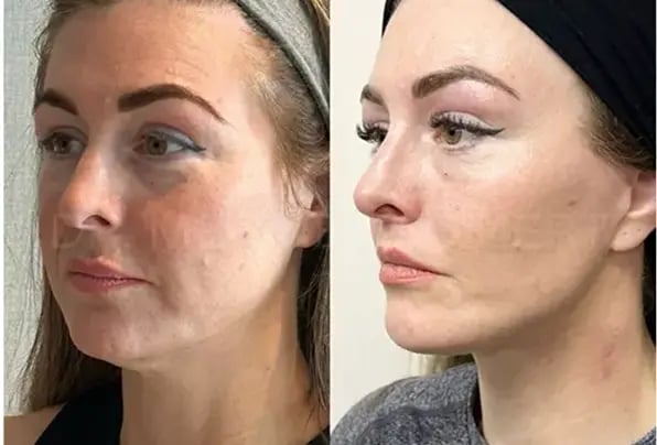 facelift